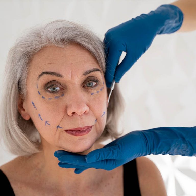 1 facial fat grafting (1)