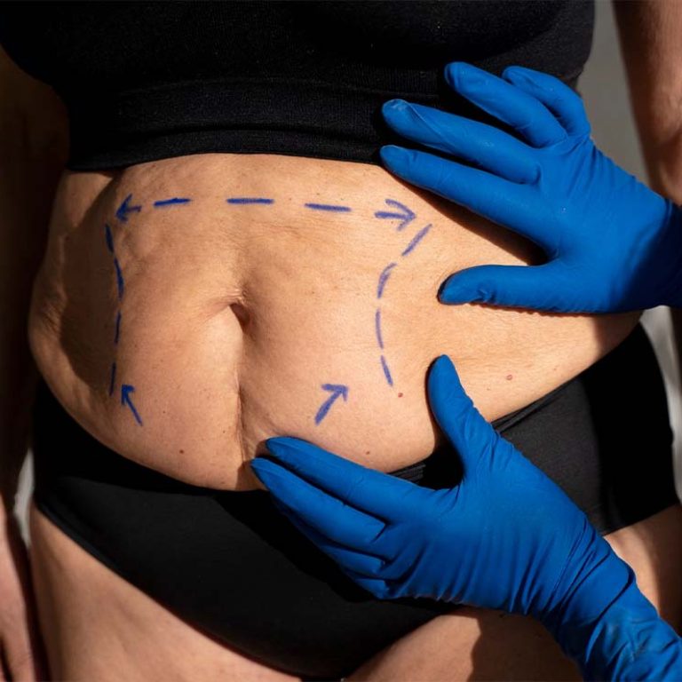 1 liposuction