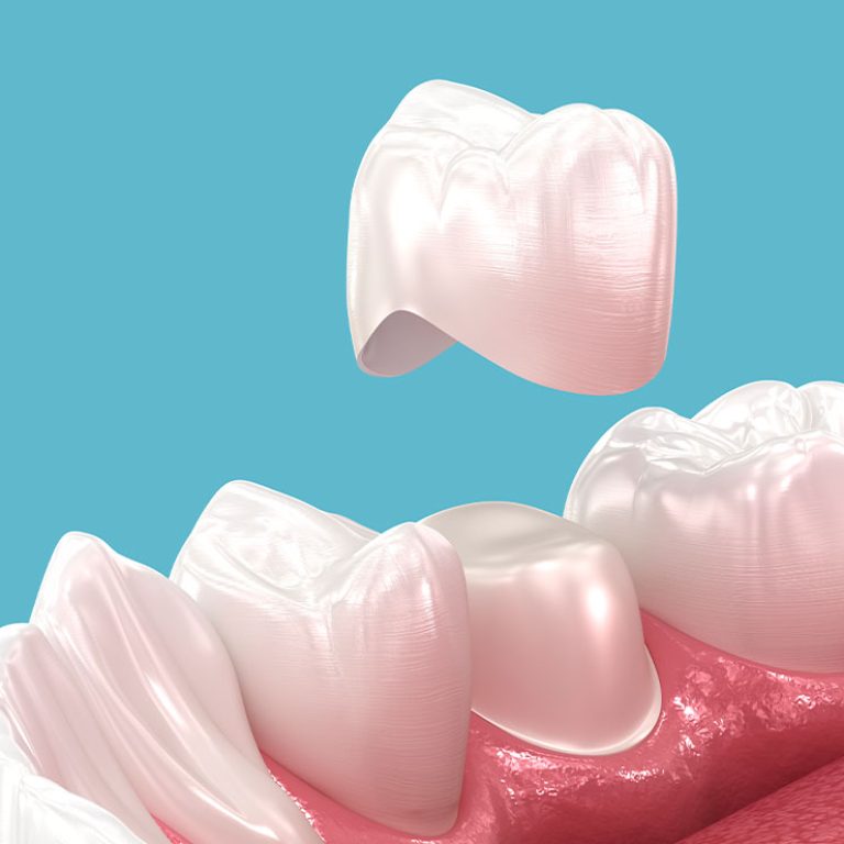 Dental Crowns1