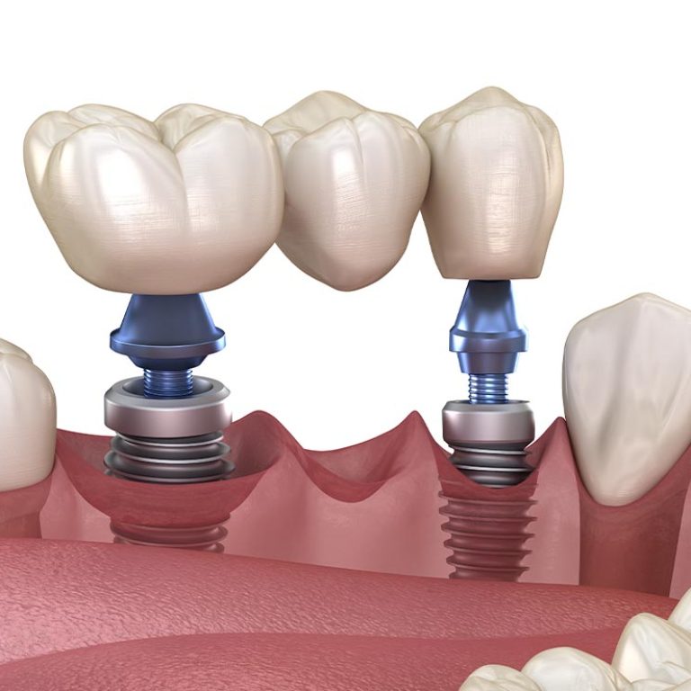 Dental implant1