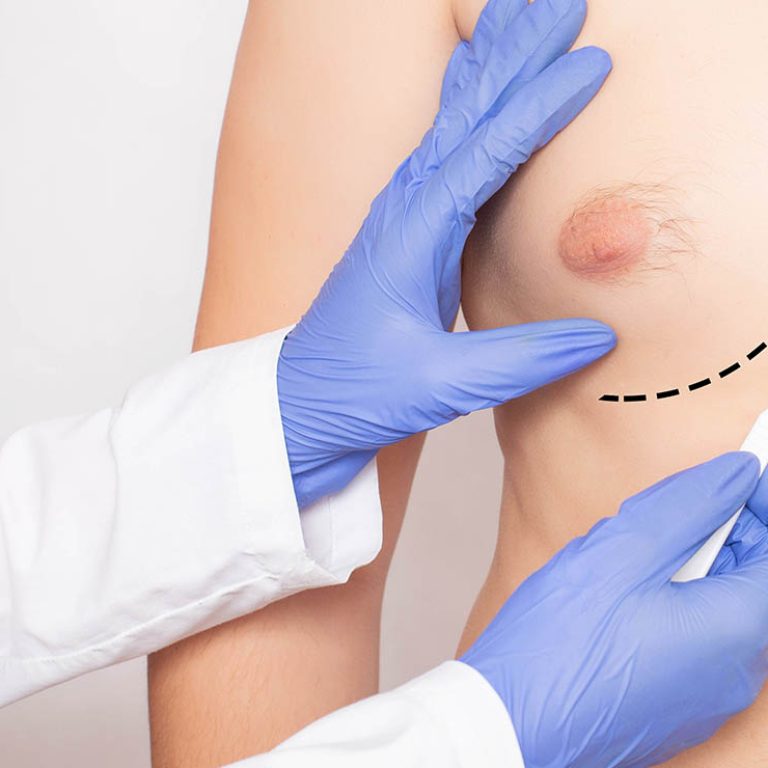 Gynecomastia Surgery (Male Breast Reduction)1