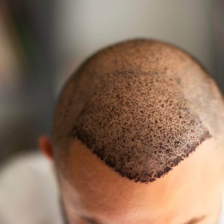 Hair Transplant1