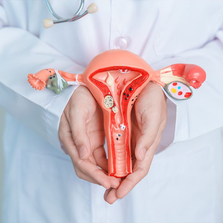 Hysterectomy Surgical removal of the uterus1