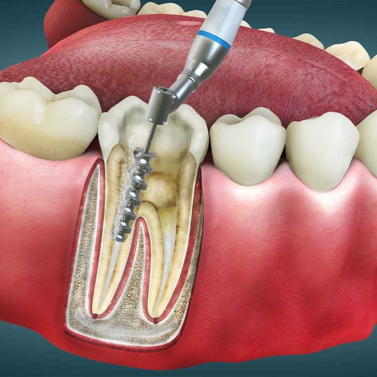 Root Canal Treatment1