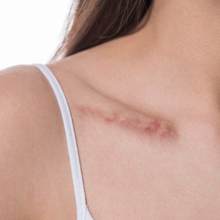 Scar Correction Surgery 1