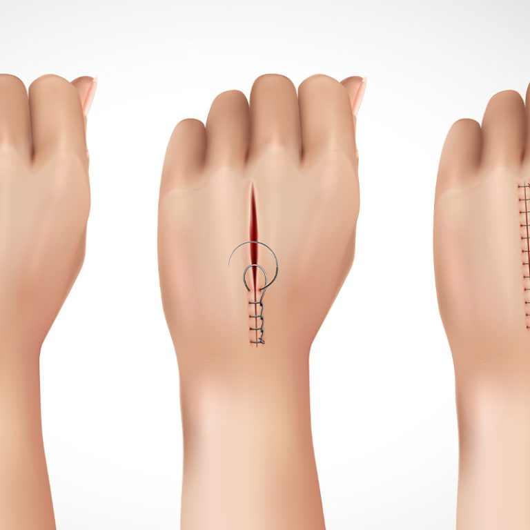 Skin grafts and flap surgeries1