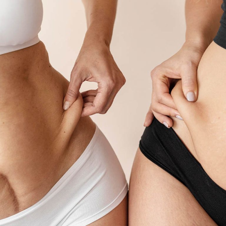 Tummy tuck 1