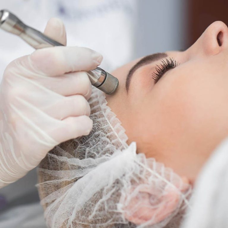 microdermabrasion1